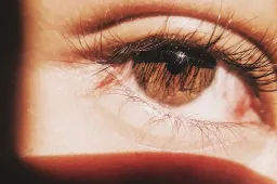 Kokios priežastys sukelia astigmatizmą?