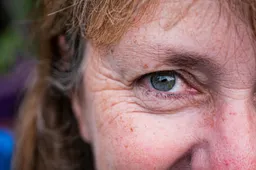 Kaip įveikti odos grožį darkančius kapiliarus?