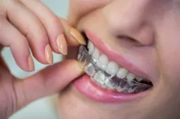 Tiesinimo kapos: ar jos veiksmingesnės už metalinius breketus?