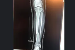 MotoGP, incidente per Mika Kallio: frattura di tibia e perone