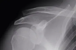 Superbike: Sylvain Guintoli sarà operato alla clavicola destra