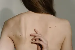 huidkanker