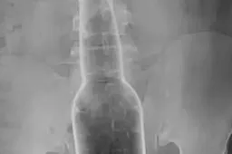Een man krabt zijn rug met een 17 centimeter lang flesje die plotseling in zijn anus schiet