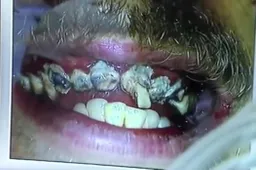 Vuilnisman poetst al 20 jaar zijn tanden niet