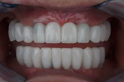 De Turkey Teeth-trend: Is het de hype waard?