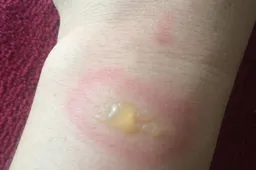 Mi Band 2 owners reporting wrist burns