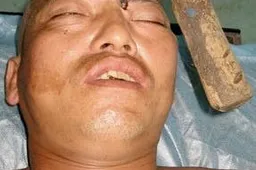 Chinese Builder Recovering After Hammer in the Head!