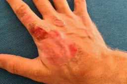 Grosjean has one hand out of bandages: "Makes me super happy"