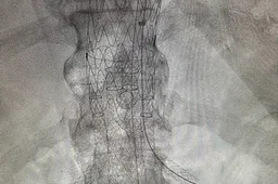 stent-vaatchirurgie-WEB