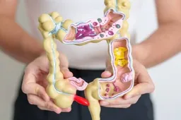 afbeelding darmkanker