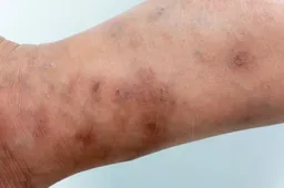 DERDE WERELD: Nederland verandert in smerig hol, schurft-epidemie explodeert nu ook in verpleeghuizen en crèches