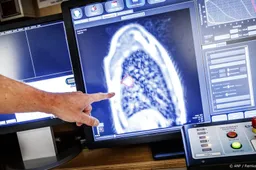 Acht op de tien patiënten ervaren klachten door bestraling