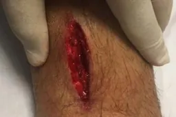 Roma-speler toont zijn vreselijke blessure