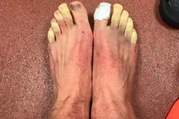 De bevroren voeten van deze topspeler gaan de wereld rond (Foto)