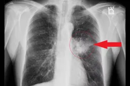 Adenocarcinoma-of-the-lung-body2