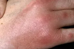 VWH-DermNetNZ-Panniculitis-01-76febbb615f4442988c74db6a46187ba