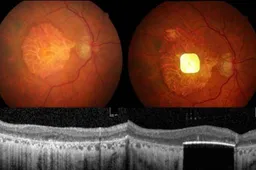 Low-Res_Implant in eye