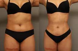 rib-remodeling--297-front-detail