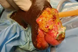 cancer-penis