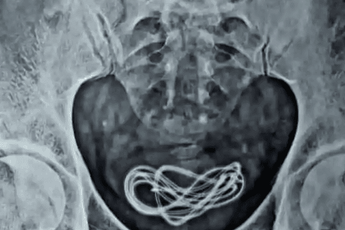 Shocking! Charging cable extracted from man's bladder