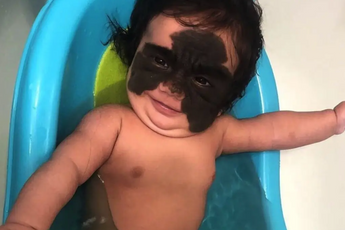 Pasgeboren meisje werd 'Batman' genoemd door grote zwarte vlek in haar gezicht - kijk hoe ze er nu uit ziet