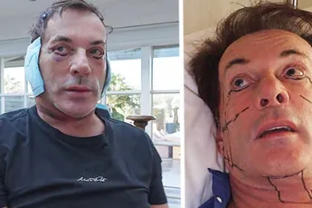 /show-tel/gerard-joling-onherkenbaar-na-plastische-chirurgie