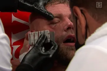 'Ik voelde het strijkijzer mijn oogkas inglijden': Billy Joe Saunders over gruwel blessure