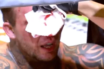 'Ik beet zijn oor eraf... hij rukte bijna mijn oog uit!' Bare knuckle bokser geeft inkijkje in wereld van ondergrondse gevechten