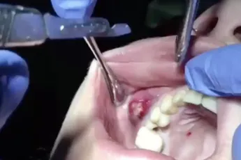 Abces in mond laten poppen