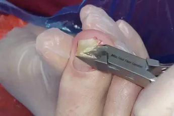 Miss Foot Fixer verwijderd nagel