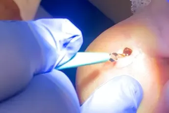 De splinter van Jake die er prachtig uit kwam