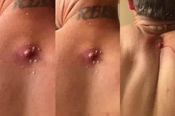 Gast laat puist poppen met zijn schouderbladen