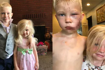 6-jarige Bridger flink toegetakeld nadat hij zijn zusje heeft gered van hondenaanval