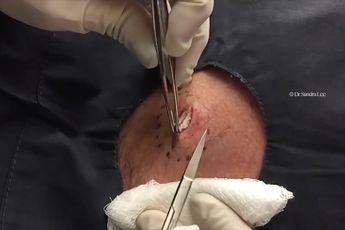 Iemand met Bermuda Driehoek in praktijk Dr. Pimple Popper