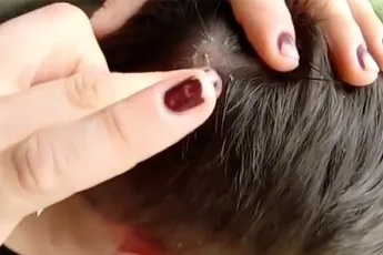 Leuke souvenir uit Panama: Horzel larve in je hoofd...