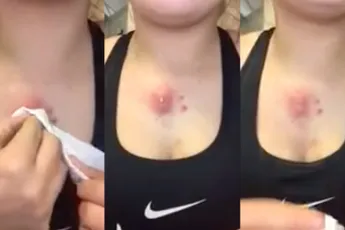 Meisje knijpt echt ranzige grote puist uit!