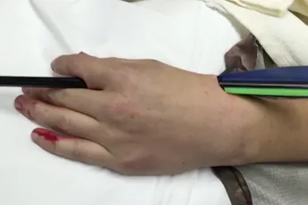 Pijl door je hand geschoten, en nu?