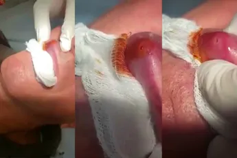 Wat je dus ook niet wilt hebben: Larve van horzel in je lip