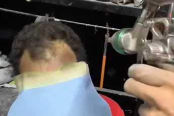 Teruglopende haarlijn fixen op Mexicaanse wijze