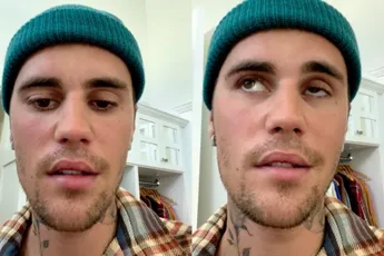 Halve gezicht van Justin Bieber verlamd