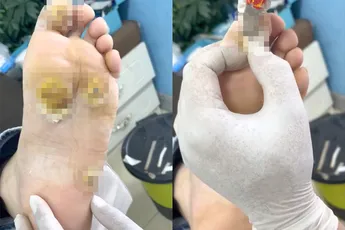 Voor de liefhebbers: Voet met eeltpitten krijgt behandeling