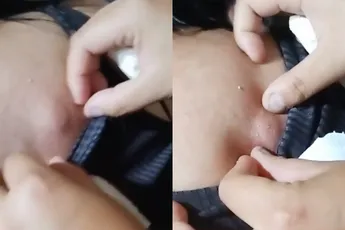 Help je iemand van puistje af, krijg je de volle laag