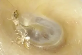 Toch maar even naar de KNO-arts na constant geluid en jeuk in oor…