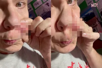 Weer zo’n lekker ranzig filmpje van enorme puisten