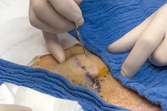 Dokter John doet dermatologische dingen die vast niet iedereen kan waarderen