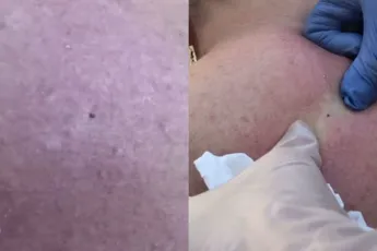 Onderhuidse zak vol ellende moest uitgedrukt worden