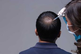 Wat kun je verwachten na een haartransplantatie?