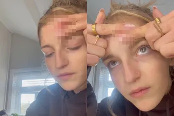 Puist op je voorhoofd? Roxy perst 'm live leeg en gaat viraal