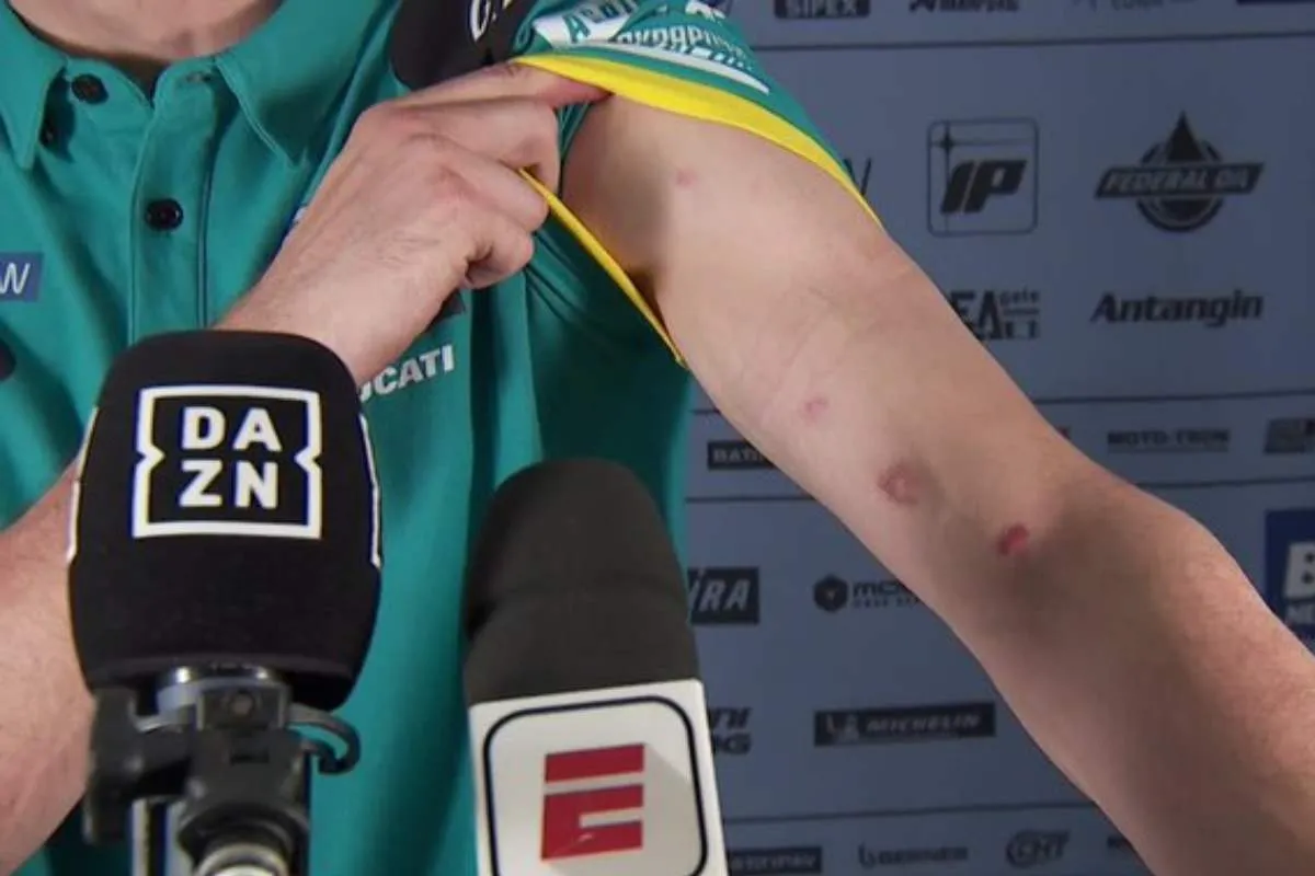 Il braccio ferito di Alex Marquez dopo la gara MotoGP a Goiania, Brasile