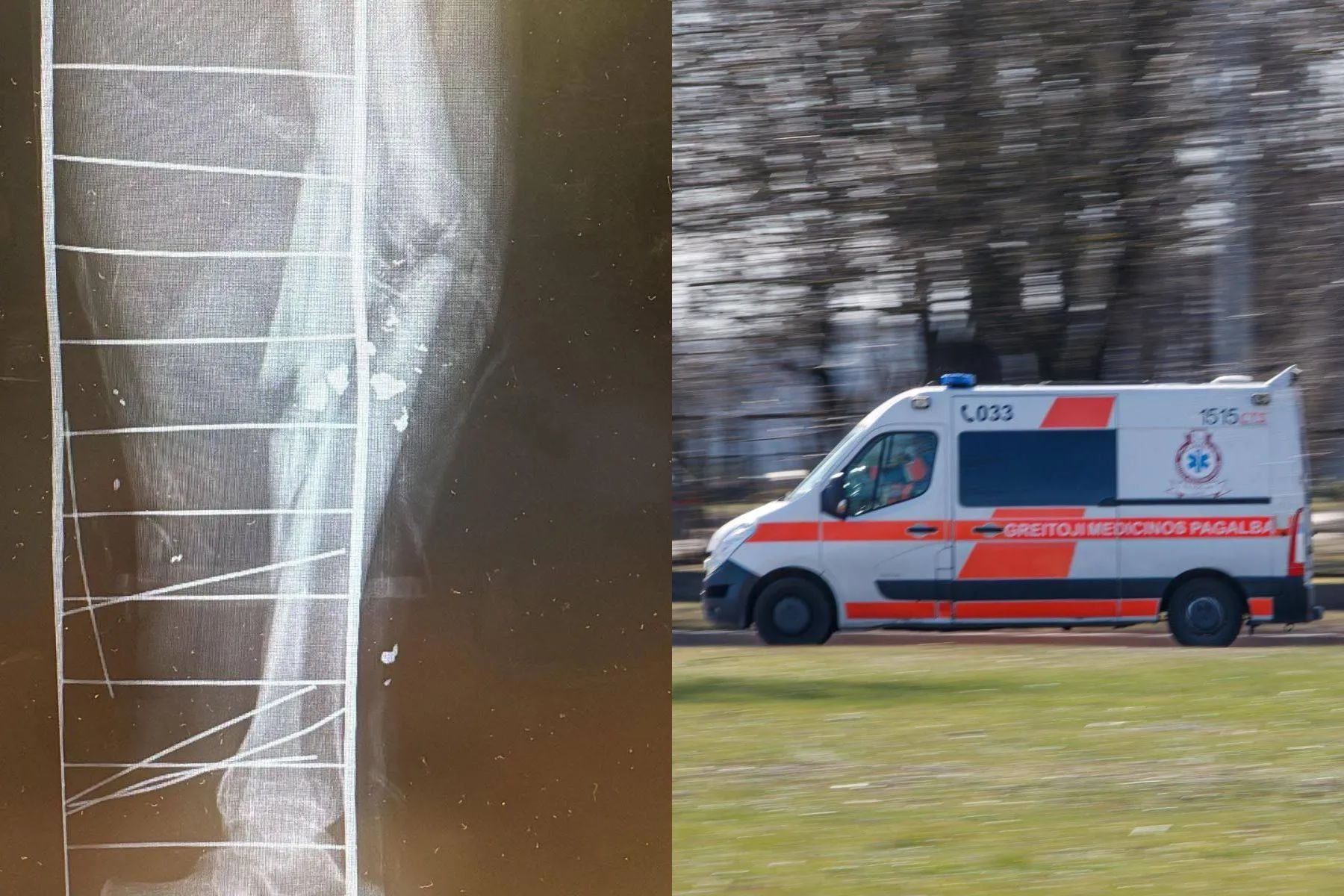 Lūžis, trauma, greitoji pagalba